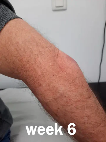 Week 6 Elbow Testimonial