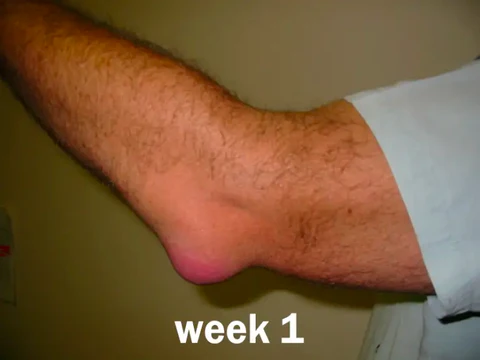 Week 1 Elbow Testimonial